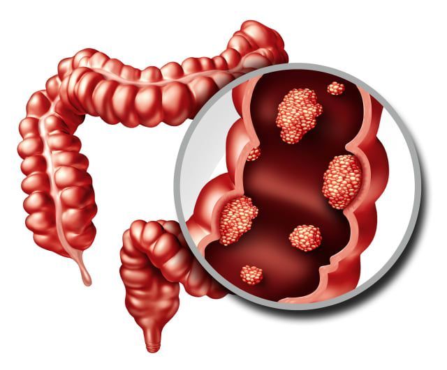 Colon Cancer Treatment Review for Dubai Patients - Dr. Ajeet Tiwari