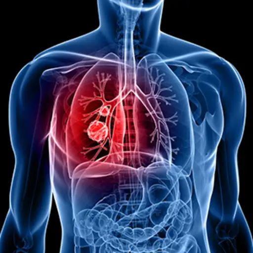 Lung Cancer Treatment Review for Dubai Patients - Dr. Ajeet Tiwari
