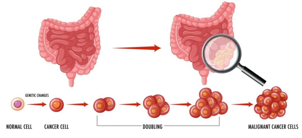 Best Hospital for Stomach Cancer in Dehradun