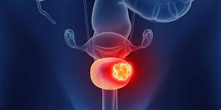 best bladder cancer doctors in Dehradun